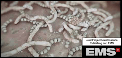 bacteria peri implantitis