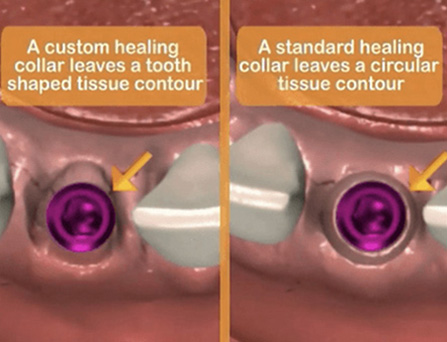comparing custom healing collar and standard healing collar