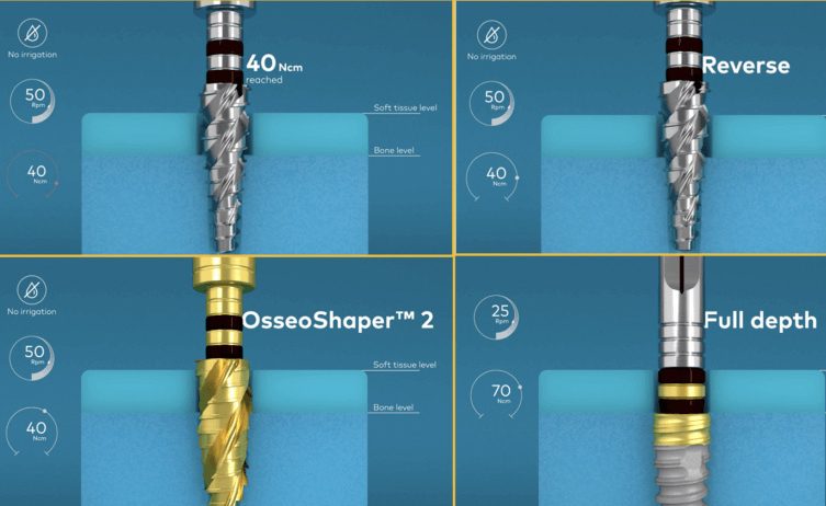 info graphic with a drill 50 rpm reverse and osseoshaper 2 50 rpm full depth