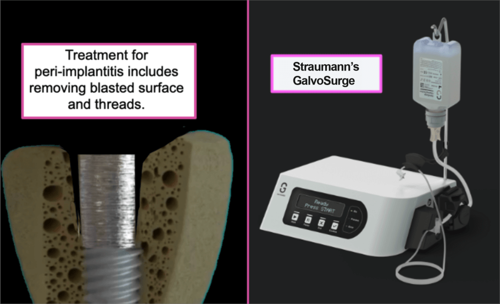 on the left is a side view of a tooth and explaining the treatment for peri implantitis