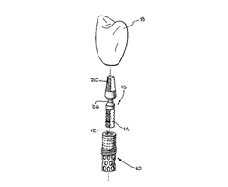 patent for core vent bendable adapter for dental implant