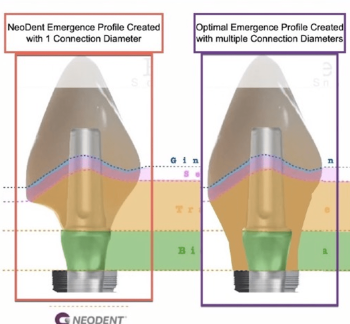 comparing neodent emergence profile versus optimal emergence profile