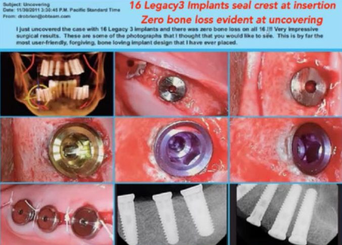 legacy 3 implants in the mouth and xrays showing the implants
