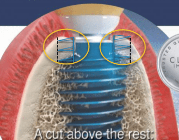 megagen implant with a cut above the rest
