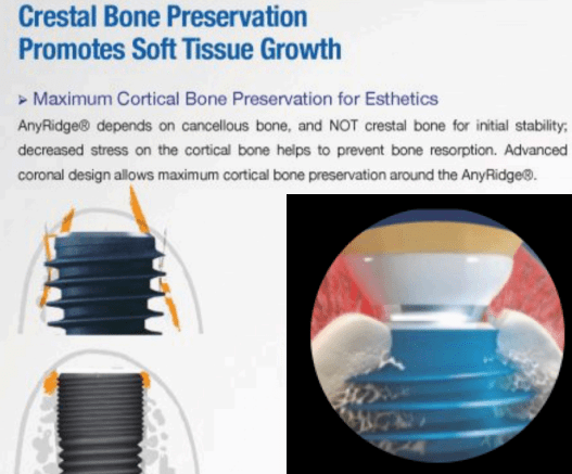 anyridge implant threads