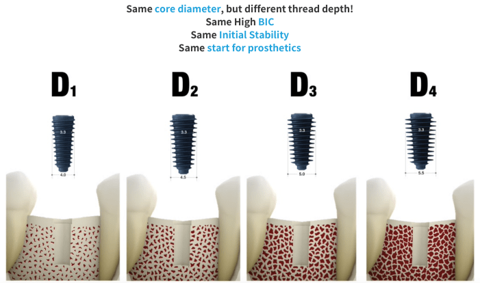 megagen implant with four implant diameters and different thread depths