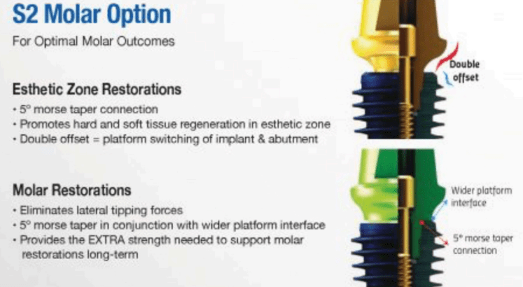 megagen anyridge implants with information on esthetic zone restorations and molar restorations