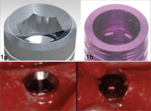 two internal implant abutment connections hexagon and conical connection and two are inserted in the mouth
