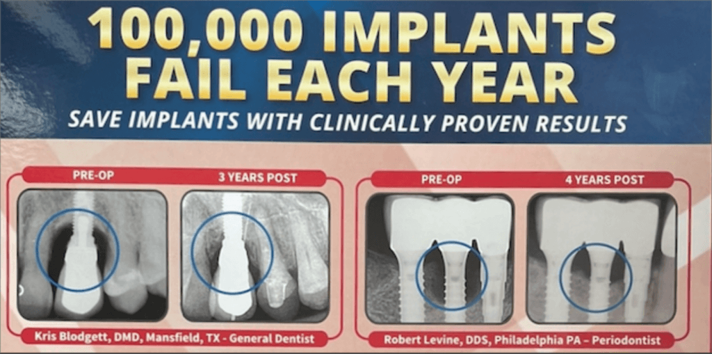 pre-op dental implant with a 3 years post and 4 years post results