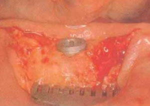 top of an implant which is 15 mm in the bone and 1 mm above the crest of the ridge